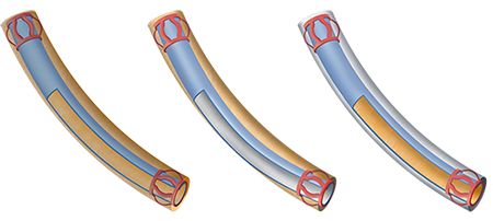 Casing Deflection between Centralizers